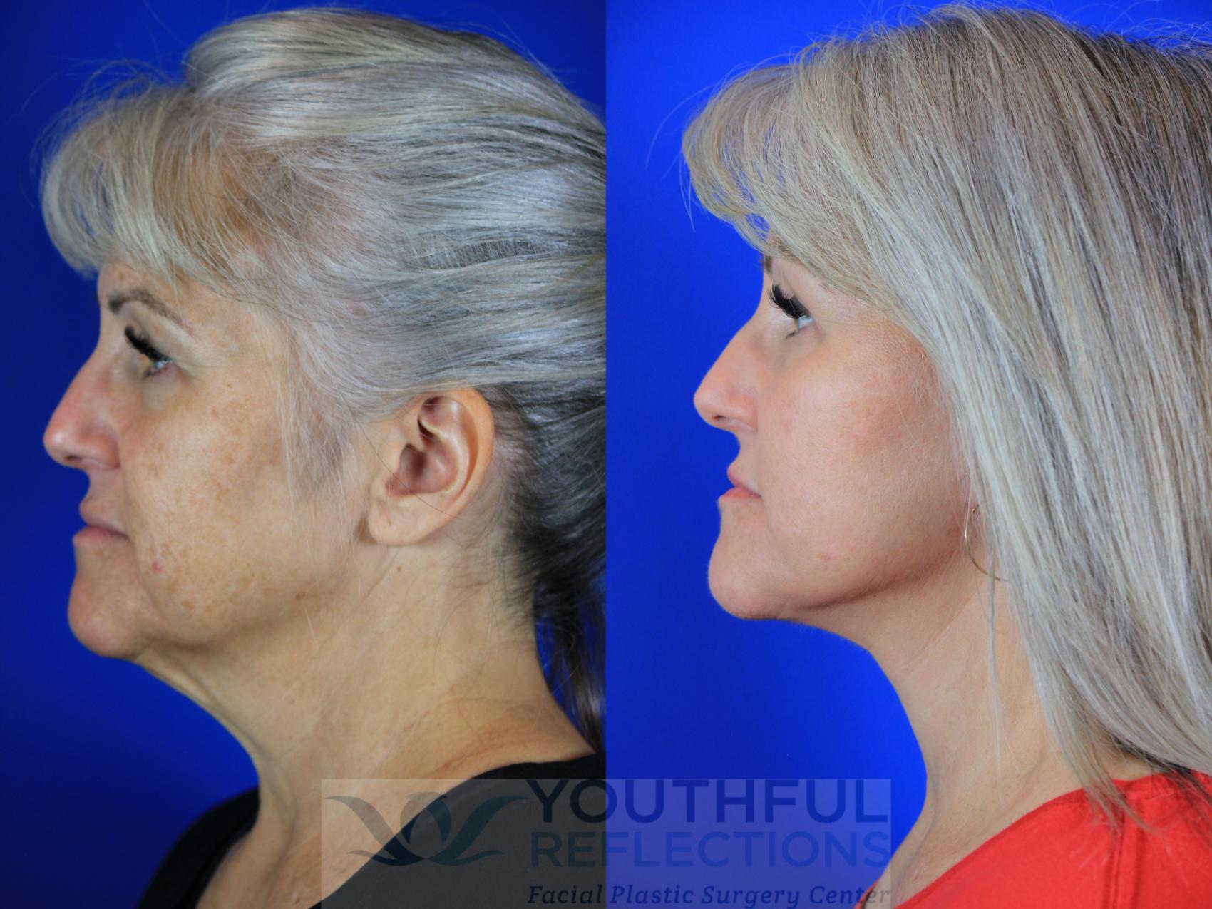 Fat Transfer Case 115 Before & After Left Side | Nashville, TN | Youthful Reflections