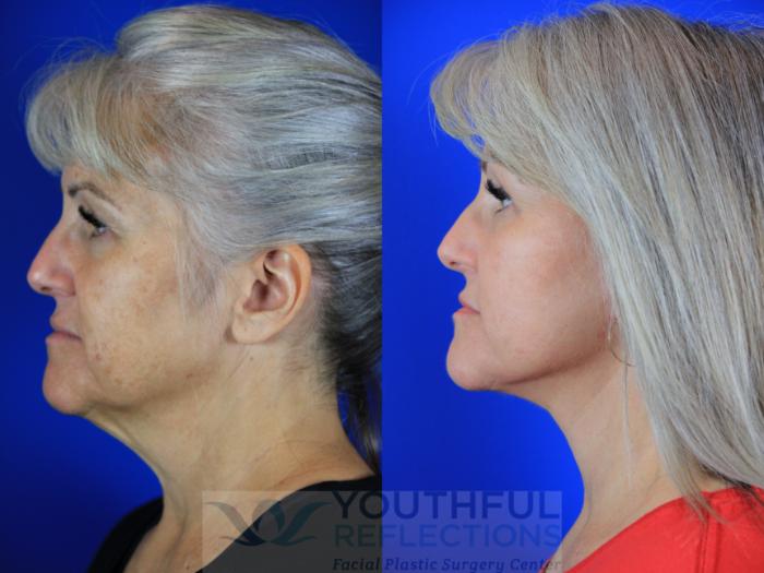 Facelift / Reflection Lift Case 115 Before & After Left Side | Nashville, TN | Youthful Reflections