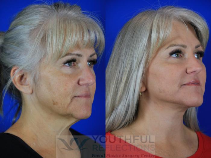 Facelift / Reflection Lift Case 115 Before & After Right Oblique | Nashville, TN | Youthful Reflections