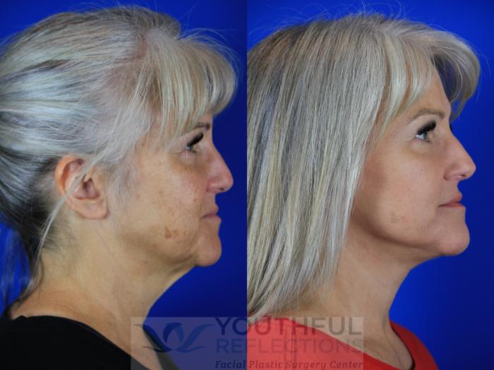 Facelift / Reflection Lift Case 115 Before & After Right Side | Nashville, TN | Youthful Reflections