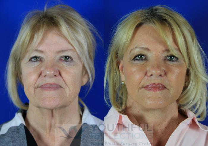 Facelift / Reflection Lift Case 116 Before & After Front | Nashville, TN | Youthful Reflections