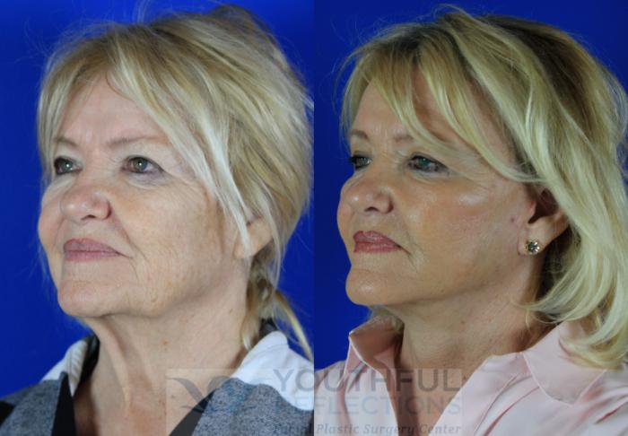 Facelift / Reflection Lift Case 116 Before & After Left Oblique | Nashville, TN | Youthful Reflections