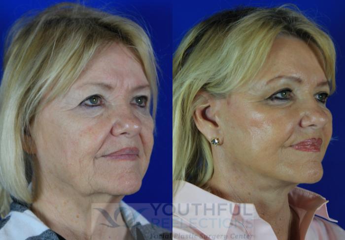 Facelift / Reflection Lift Case 116 Before & After Right Oblique | Nashville, TN | Youthful Reflections