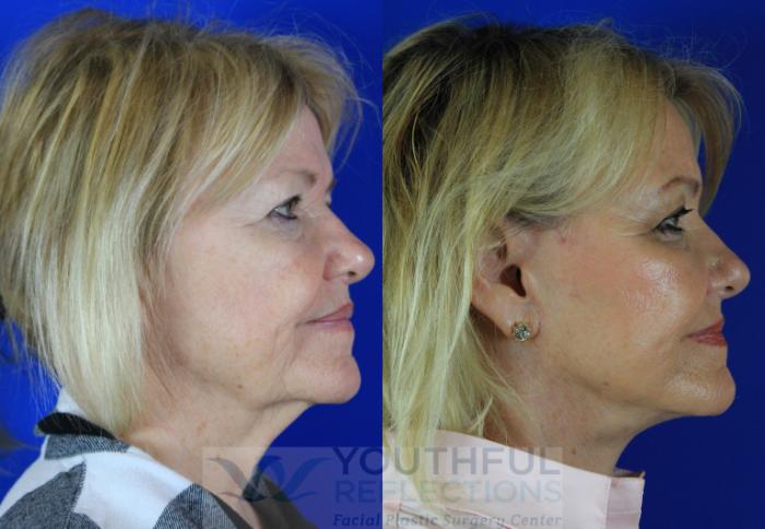 Facelift / Reflection Lift Case 116 Before & After Right Side | Nashville, TN | Youthful Reflections