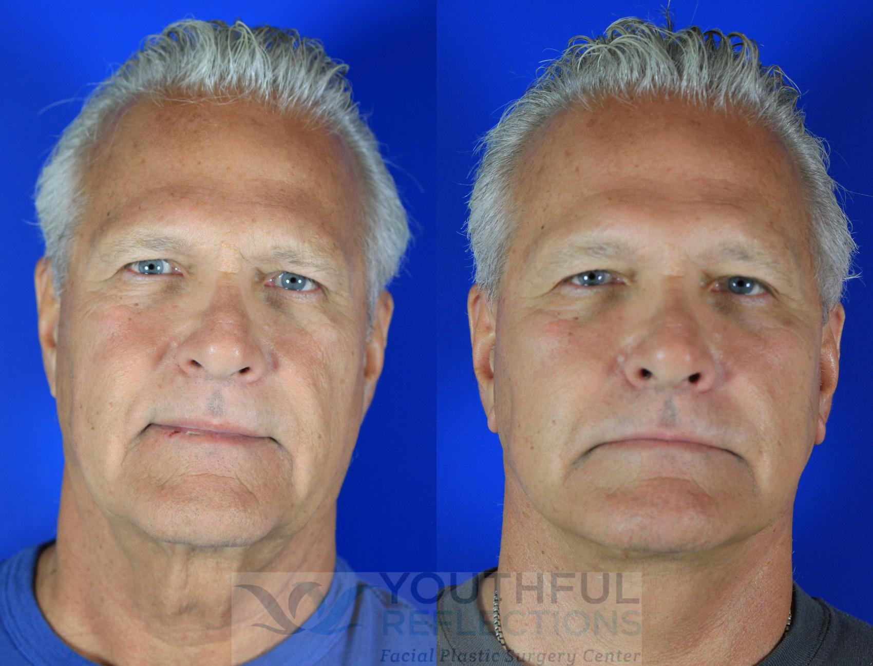 Facelift / Reflection Lift Case 119 Before & After Front | Nashville, TN | Youthful Reflections