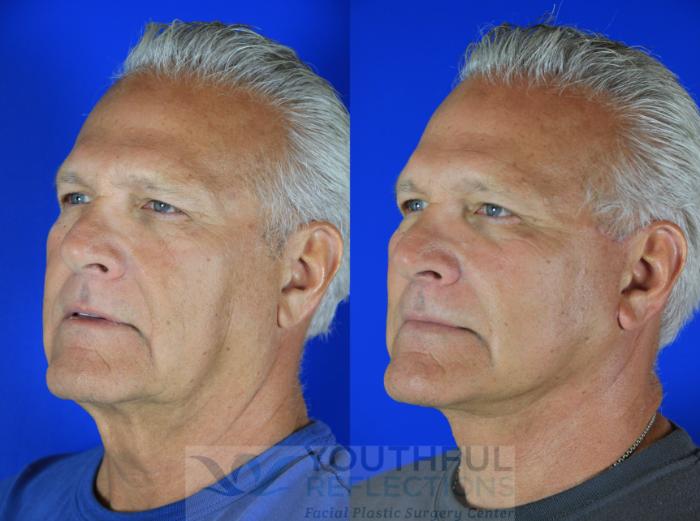 Facelift / Reflection Lift Case 119 Before & After Left Oblique | Nashville, TN | Youthful Reflections