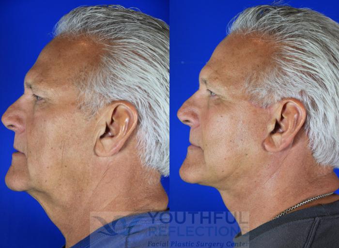 Facelift / Reflection Lift Case 119 Before & After Left Side | Nashville, TN | Youthful Reflections