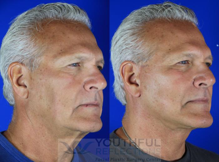 Facelift / Reflection Lift Case 119 Before & After Right Oblique | Nashville, TN | Youthful Reflections