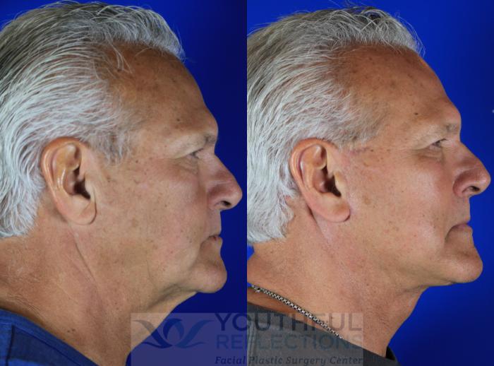 Facelift / Reflection Lift Case 119 Before & After Right Side | Nashville, TN | Youthful Reflections