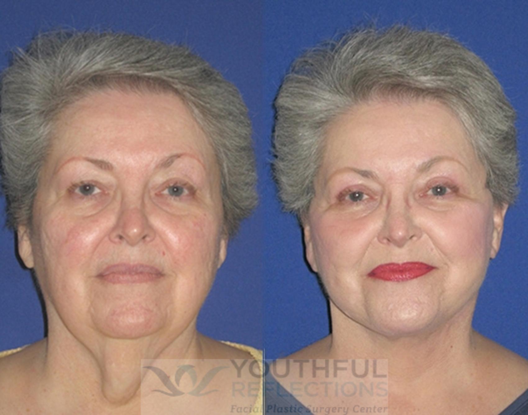 Facelift / Reflection Lift Case 12 Before & After Front | Nashville, TN | Youthful Reflections