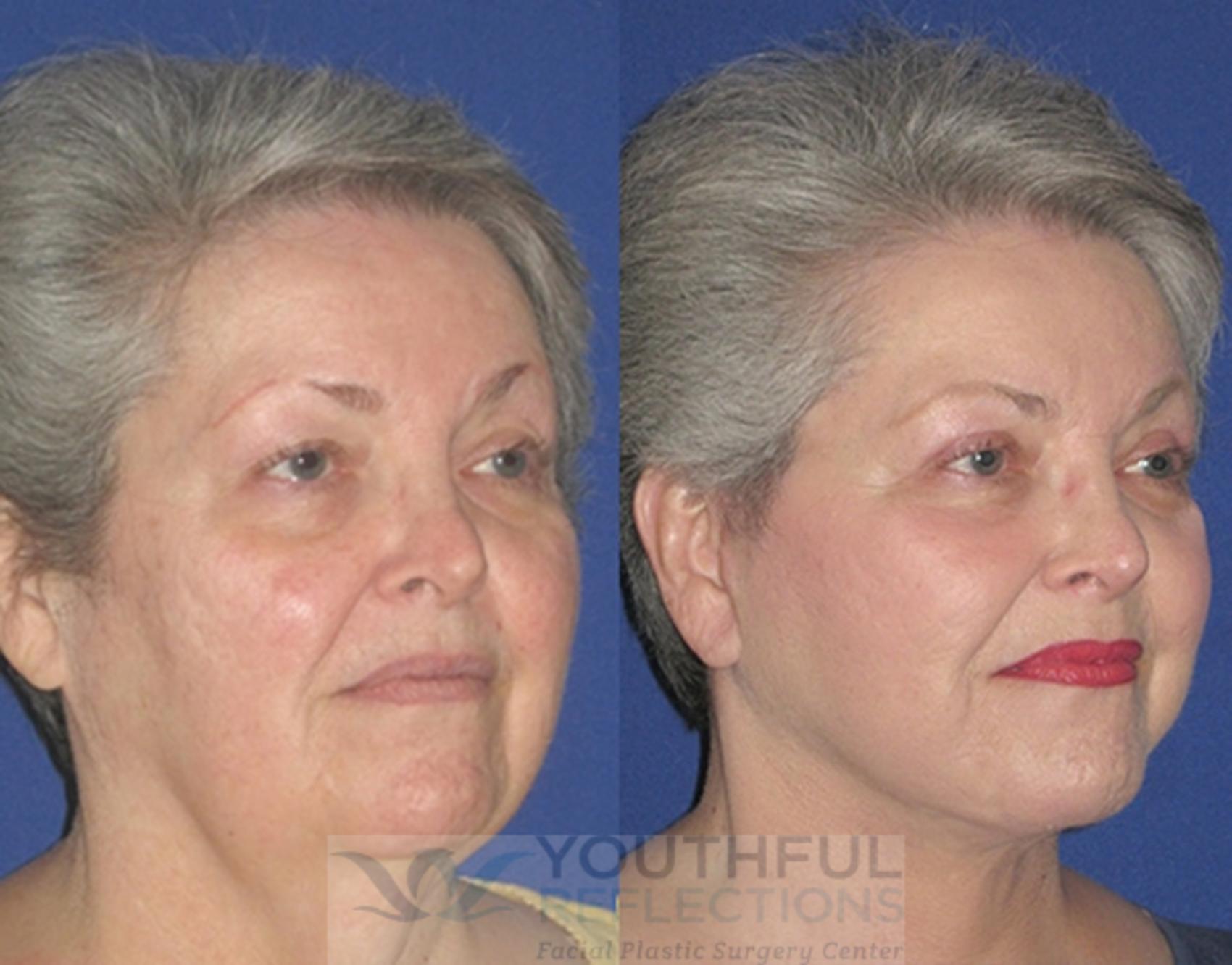 Upper Blepharoplasty Case 12 Before & After Right Oblique | Nashville, TN | Youthful Reflections