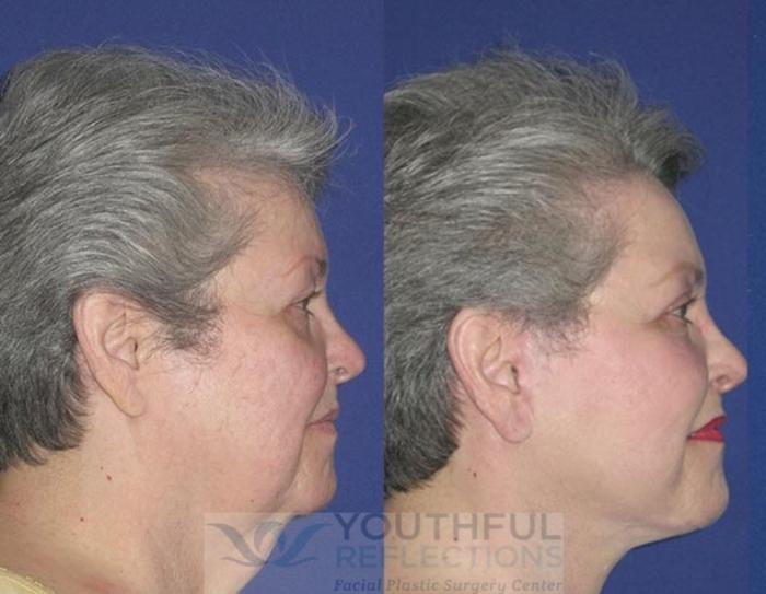 Facelift / Reflection Lift Case 12 Before & After Right Side | Nashville, TN | Youthful Reflections