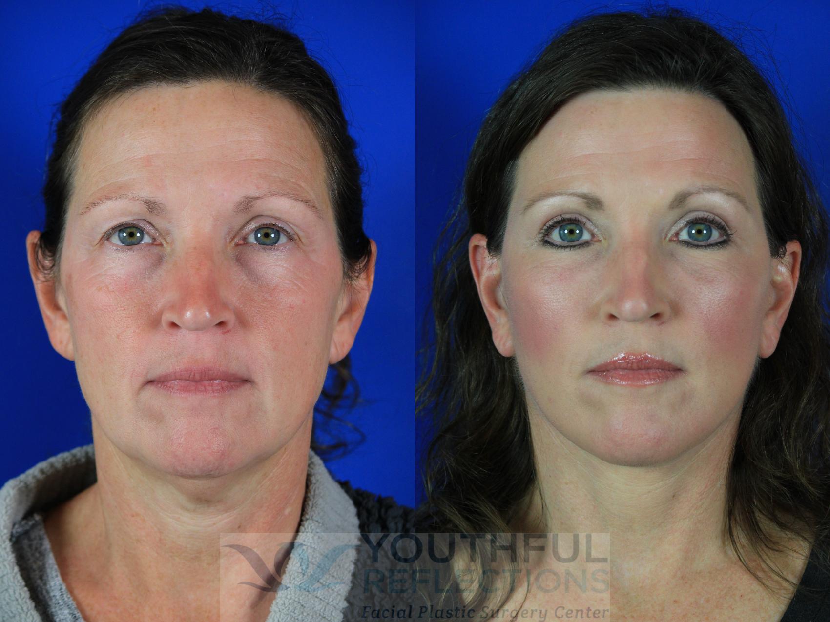 Facelift / Reflection Lift Case 126 Before & After Front | Nashville, TN | Youthful Reflections