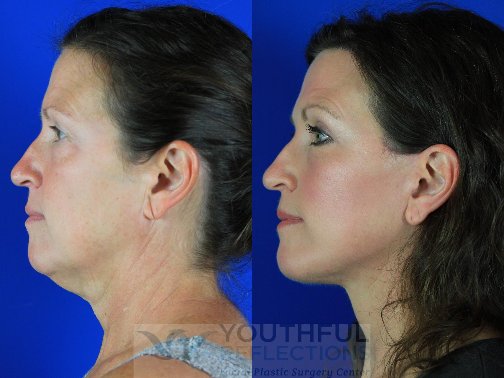 Facelift / Reflection Lift Case 126 Before & After Left Side | Nashville, TN | Youthful Reflections