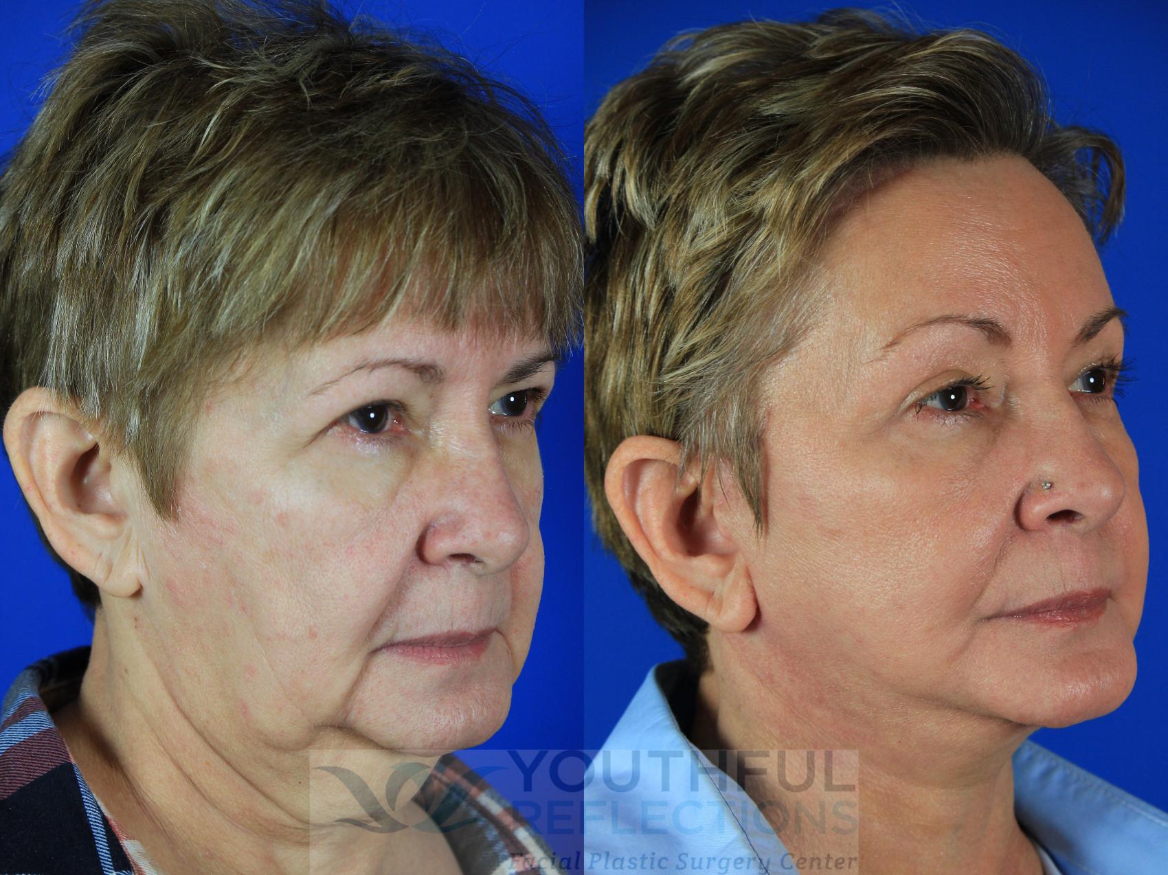 Facelift / Reflection Lift Case 128 Before & After Right Oblique | Nashville, TN | Youthful Reflections