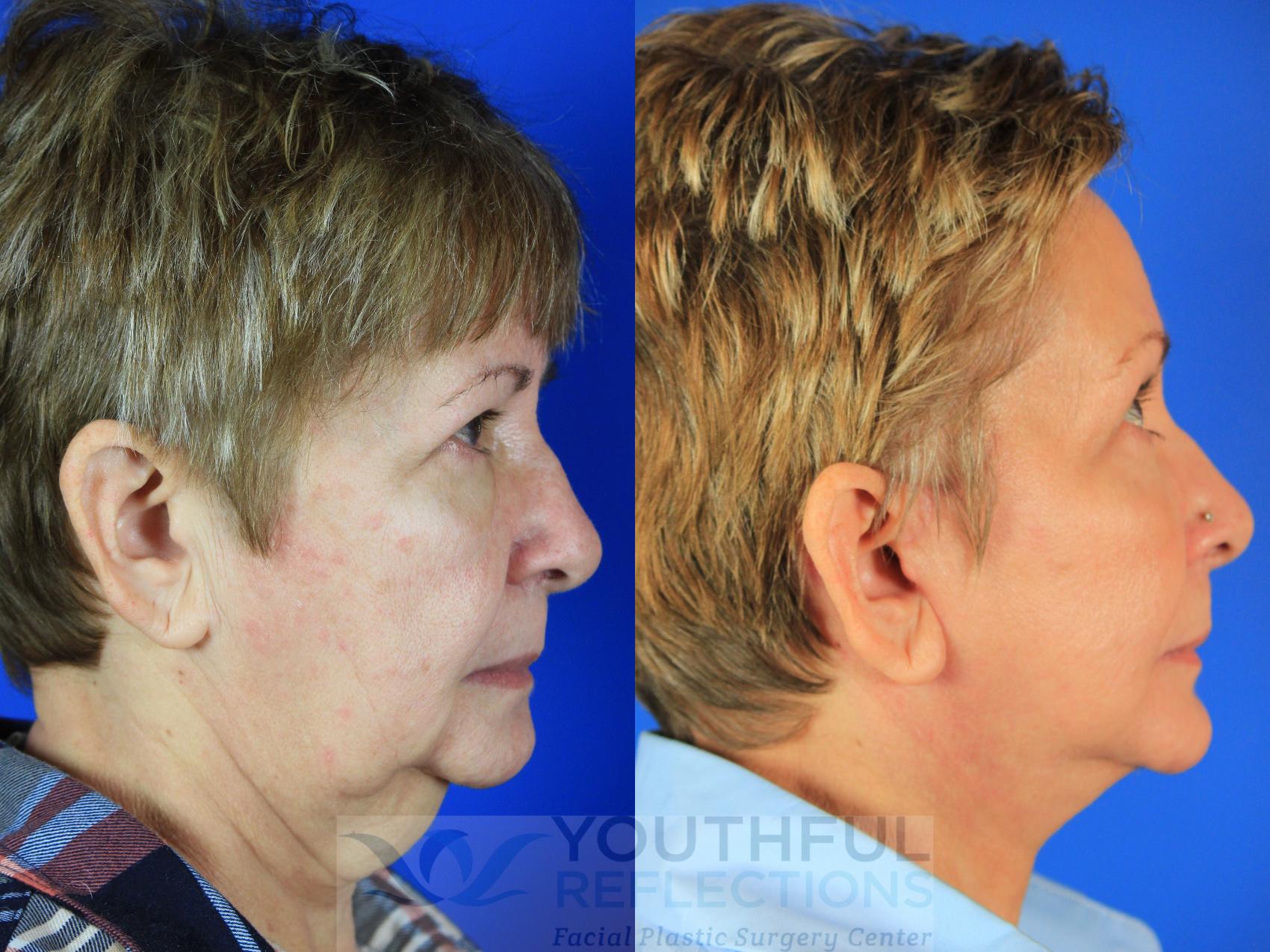 Facelift / Reflection Lift Case 128 Before & After Right Side | Nashville, TN | Youthful Reflections