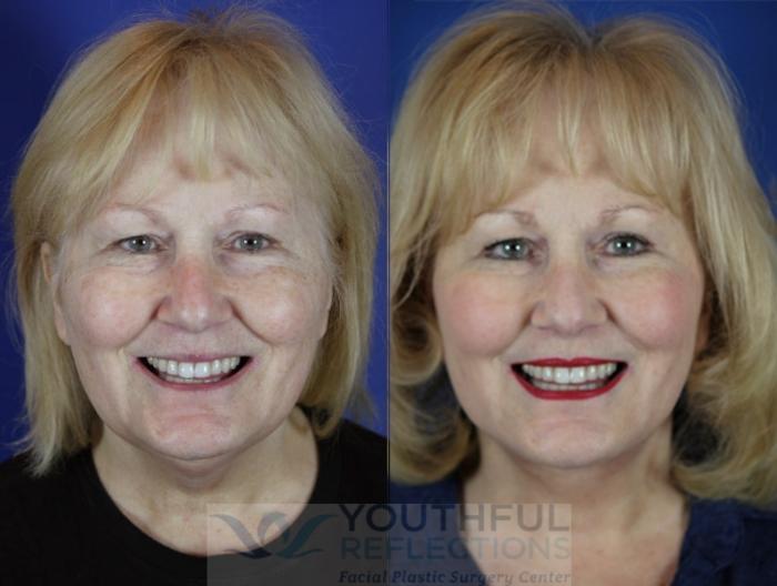 Facelift / Reflection Lift Case 13 Before & After Front | Nashville, TN | Youthful Reflections