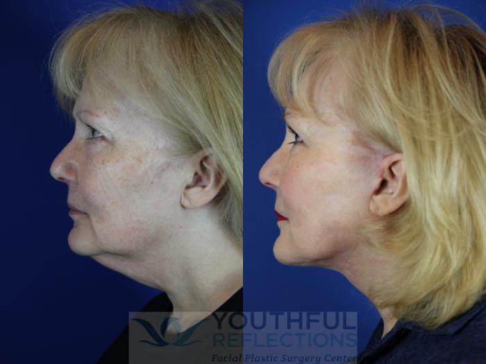 Facelift / Reflection Lift Case 13 Before & After Left Side | Nashville, TN | Youthful Reflections