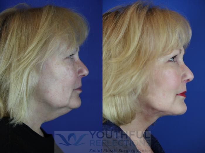 Facelift / Reflection Lift Case 13 Before & After Right Side | Nashville, TN | Youthful Reflections