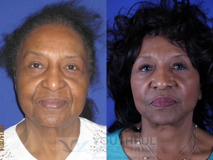 Facelift / Reflection Lift Case 14 Before & After Front | Nashville, TN | Youthful Reflections