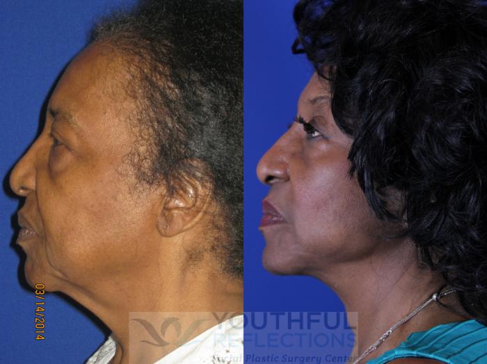 Facelift / Reflection Lift Case 14 Before & After Left Side | Nashville, TN | Youthful Reflections