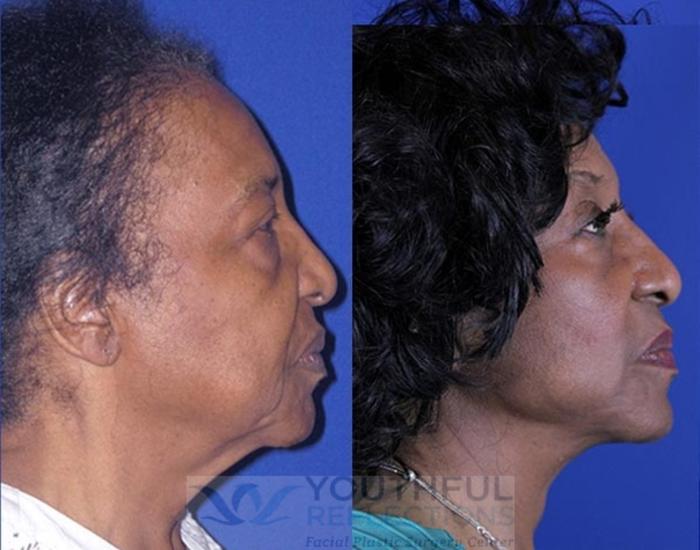 Facelift / Reflection Lift Case 14 Before & After Right Side | Nashville, TN | Youthful Reflections