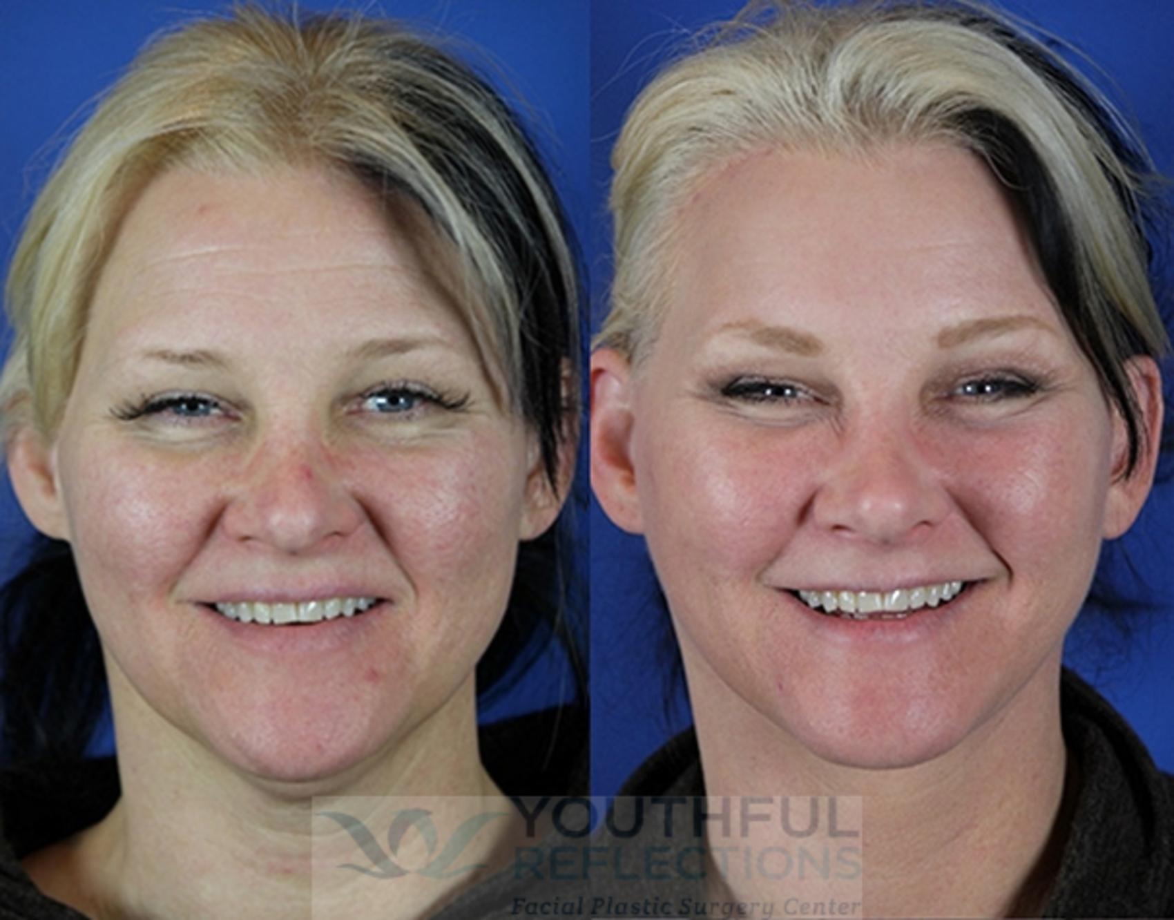 Facelift / Reflection Lift Case 15 Before & After Front | Nashville, TN | Youthful Reflections