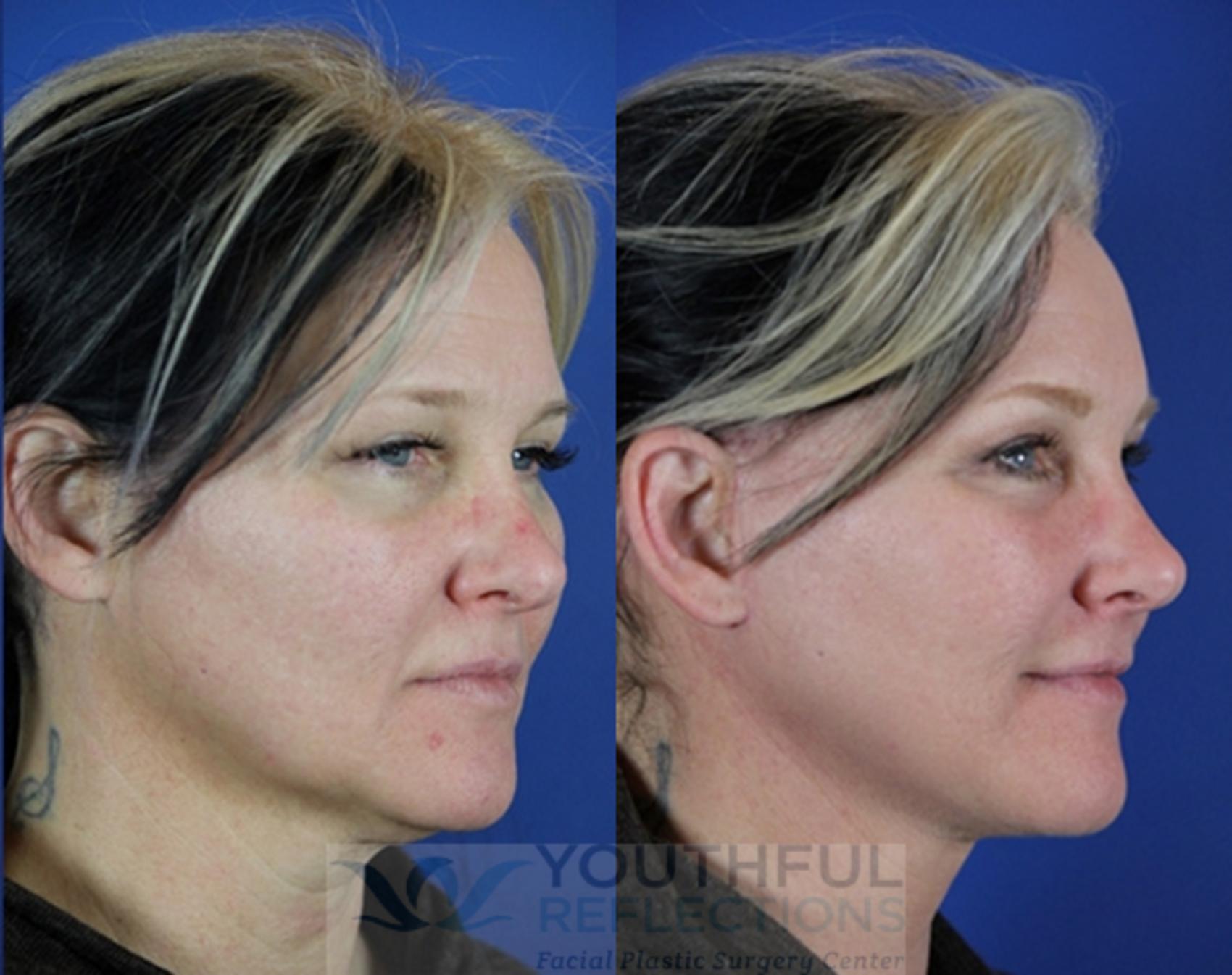 CO2 Laser Skin Resurfacing Case 15 Before & After Right Oblique | Nashville, TN | Youthful Reflections