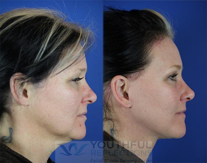 Facelift / Reflection Lift Case 15 Before & After Right Side | Nashville, TN | Youthful Reflections