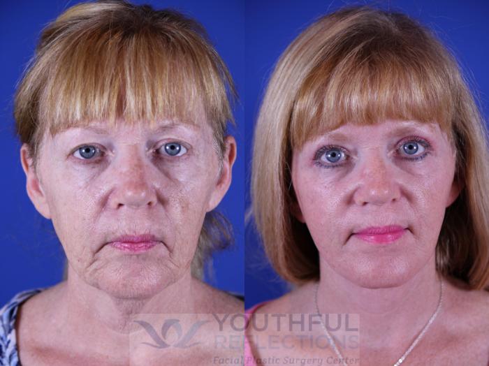 Facelift / Reflection Lift Case 16 Before & After Front | Nashville, TN | Youthful Reflections