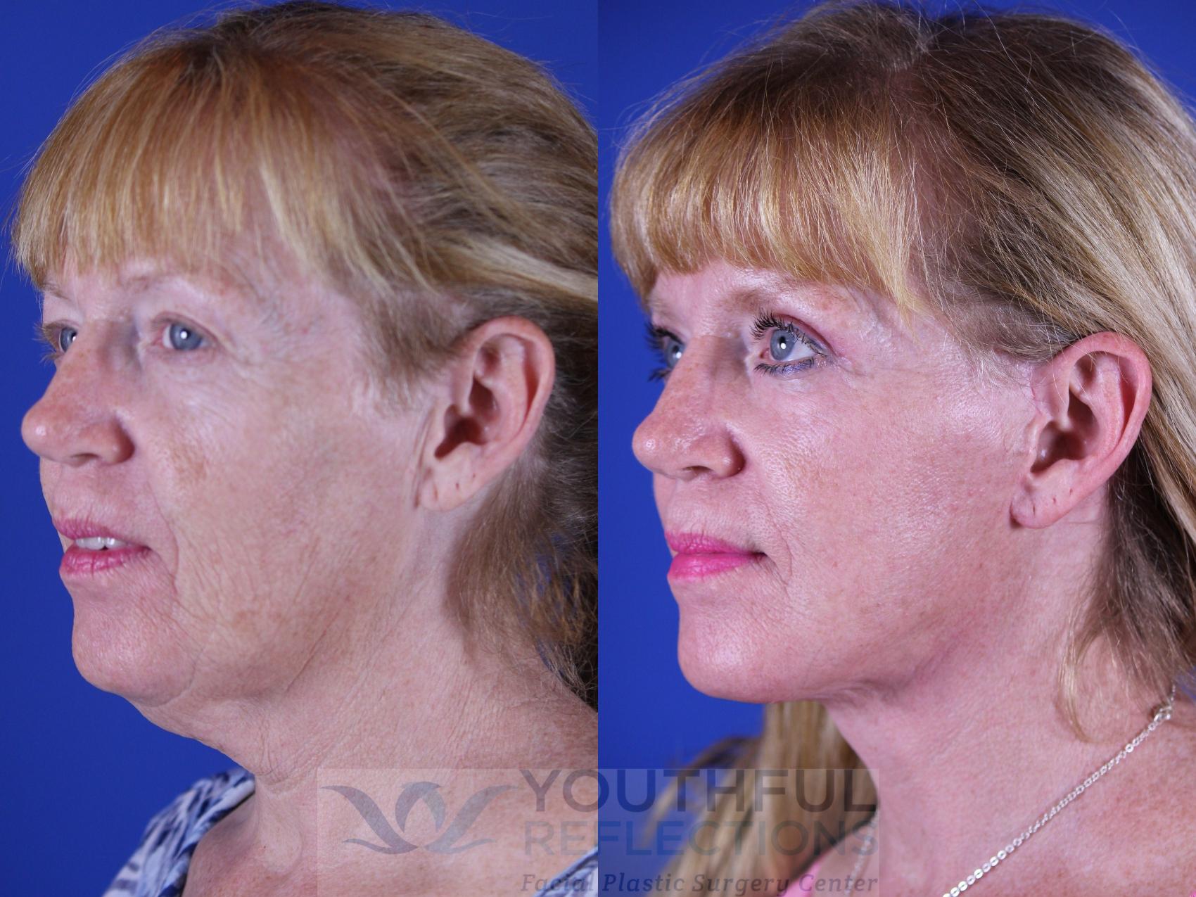 Upper Blepharoplasty Case 16 Before & After Left Oblique | Nashville, TN | Youthful Reflections