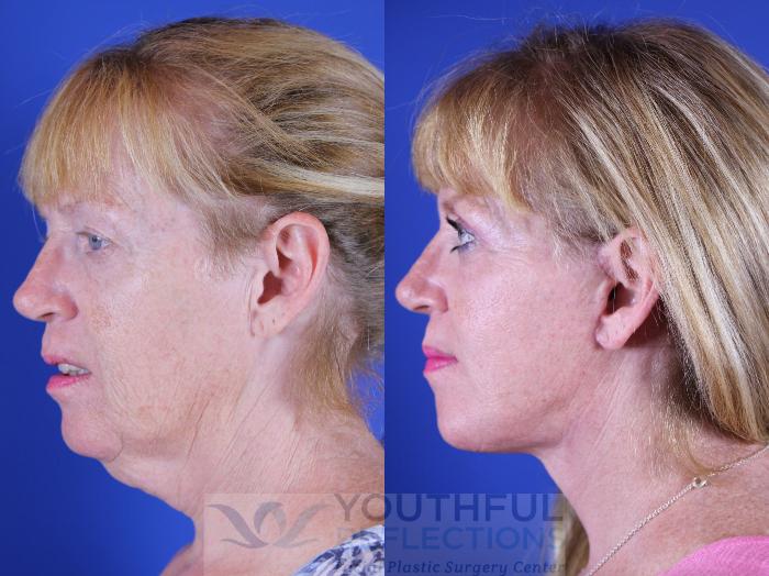 Facelift / Reflection Lift Case 16 Before & After Left Side | Nashville, TN | Youthful Reflections