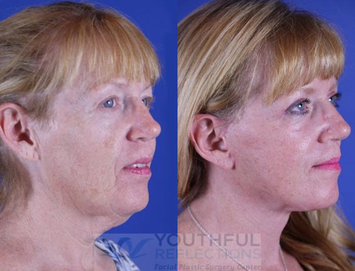 Facelift / Reflection Lift Case 16 Before & After Right Oblique | Nashville, TN | Youthful Reflections