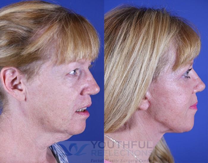 Facelift / Reflection Lift Case 16 Before & After Right Side | Nashville, TN | Youthful Reflections