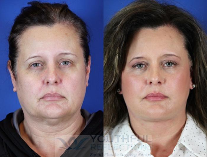 Facelift / Reflection Lift Case 17 Before & After Front | Nashville, TN | Youthful Reflections