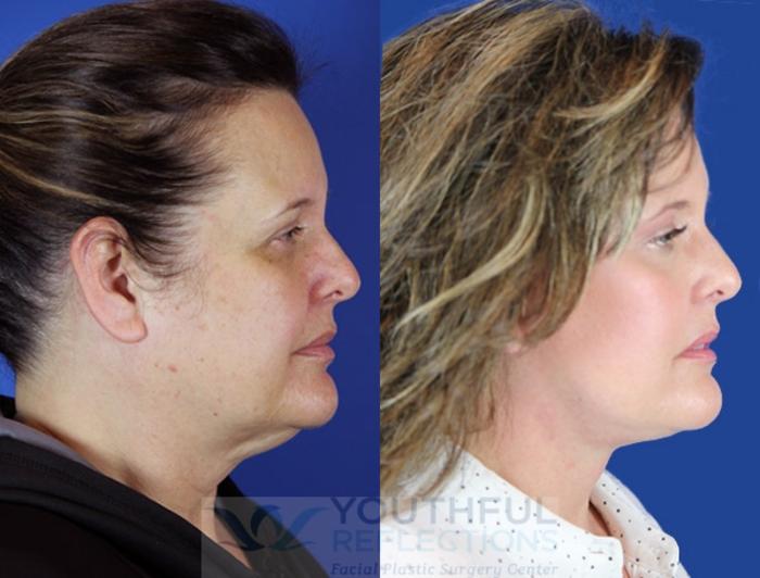Facelift / Reflection Lift Case 17 Before & After Right Side | Nashville, TN | Youthful Reflections