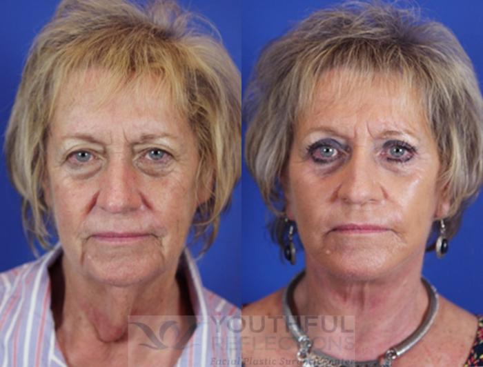 Facelift / Reflection Lift Case 18 Before & After Front | Nashville, TN | Youthful Reflections
