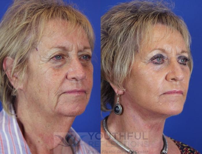 Facelift / Reflection Lift Case 18 Before & After Right Oblique | Nashville, TN | Youthful Reflections