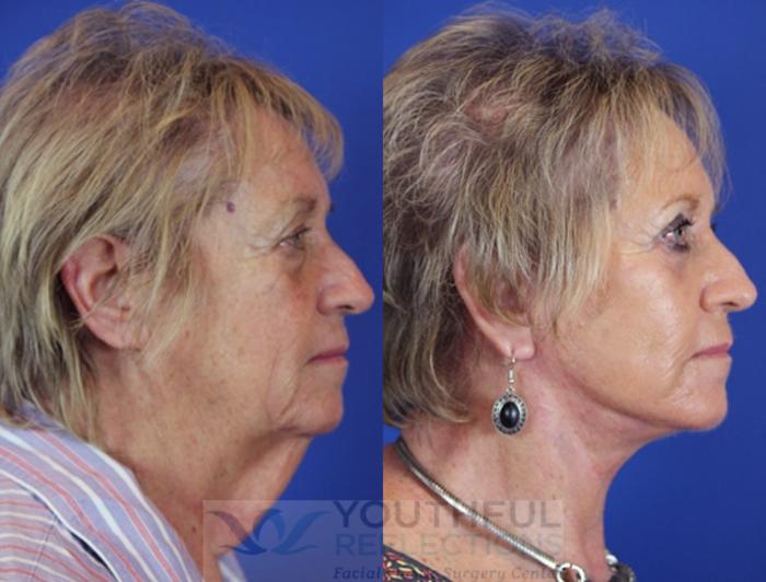 Facelift / Reflection Lift Case 18 Before & After Right Side | Nashville, TN | Youthful Reflections