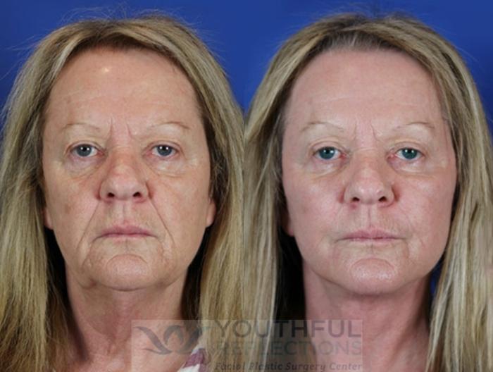 Facelift / Reflection Lift Case 19 Before & After Front | Nashville, TN | Youthful Reflections