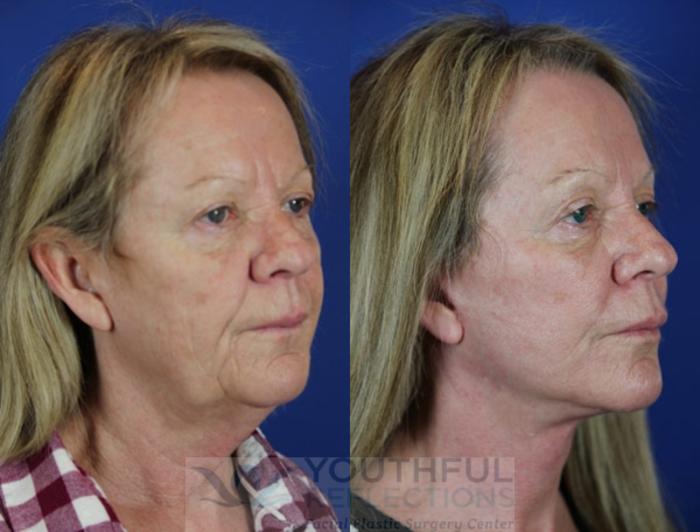 Facelift / Reflection Lift Case 19 Before & After Right Oblique | Nashville, TN | Youthful Reflections