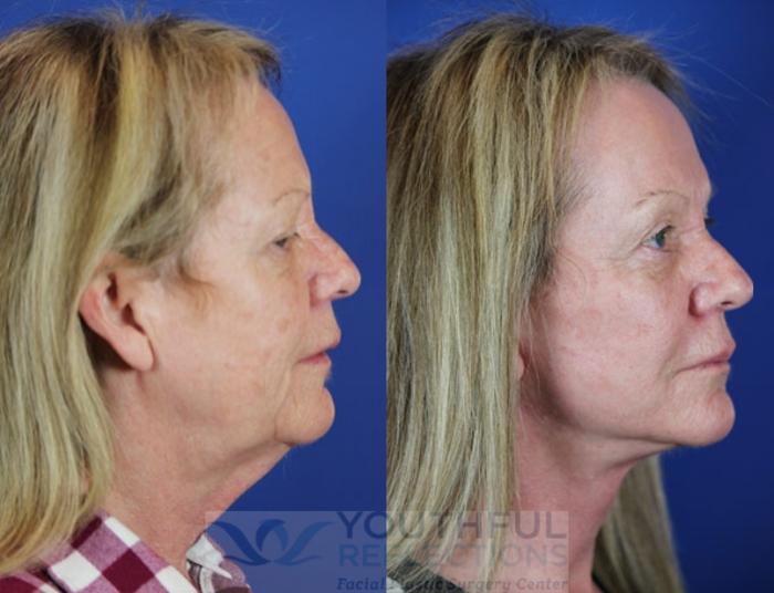Facelift / Reflection Lift Case 19 Before & After Right Side | Nashville, TN | Youthful Reflections