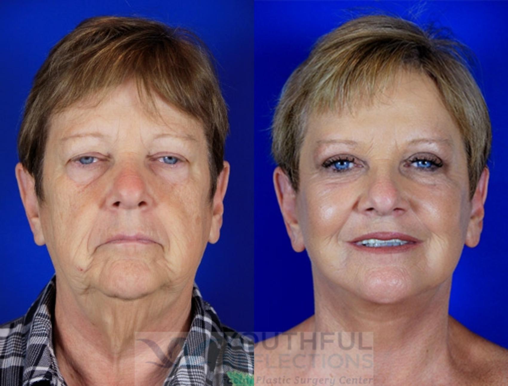 Brow Lift Case 2 Before & After Front | Nashville, TN | Youthful Reflections