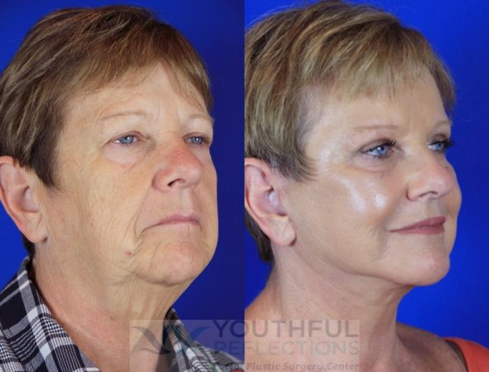 CO2 Laser Skin Resurfacing Case 2 Before & After Right Oblique | Nashville, TN | Youthful Reflections