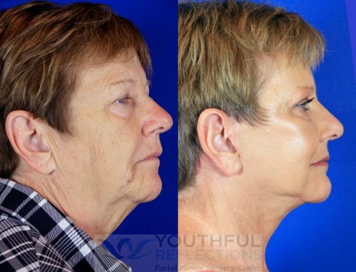 CO2 Laser Skin Resurfacing Case 2 Before & After Right Side | Nashville, TN | Youthful Reflections