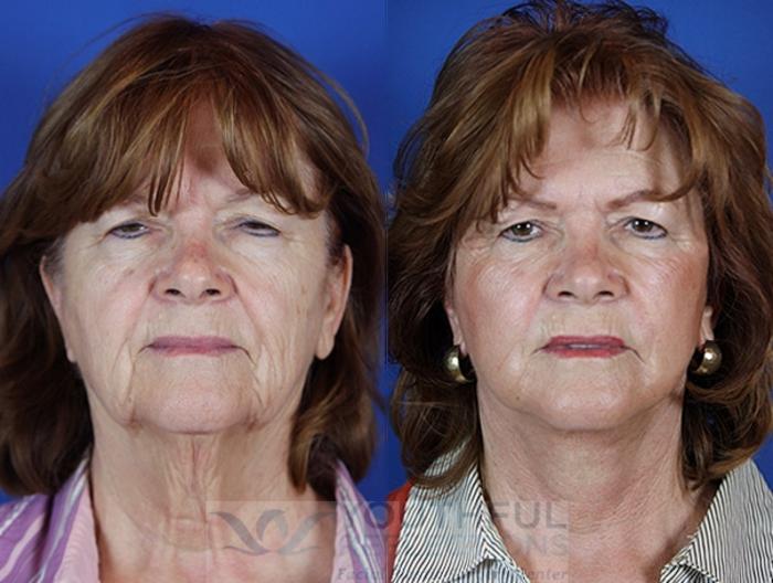 Facelift / Reflection Lift Case 20 Before & After Front | Nashville, TN | Youthful Reflections
