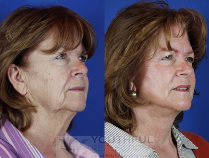 Facelift / Reflection Lift Case 20 Before & After Right Oblique | Nashville, TN | Youthful Reflections