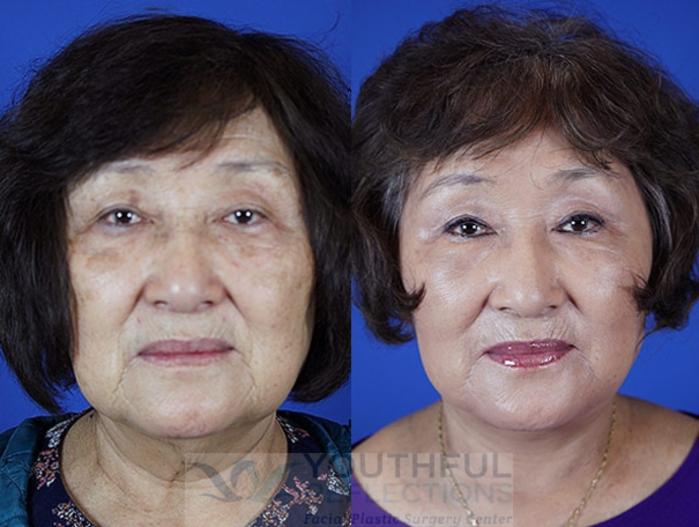 Facelift / Reflection Lift Case 21 Before & After Front | Nashville, TN | Youthful Reflections