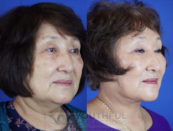 Facelift / Reflection Lift Case 21 Before & After Right Oblique | Nashville, TN | Youthful Reflections