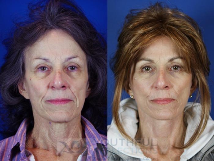 Facelift / Reflection Lift Case 22 Before & After Front | Nashville, TN | Youthful Reflections
